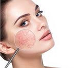 Laser Red Vein / Skin lesion Removal
