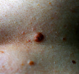 Laser Red Vein / Skin lesion Removal