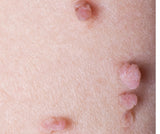 Skin Tags Removal